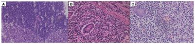 Composite diffuse large B-cell lymphoma and peripheral T-cell lymphoma: a case report with two-year follow-up and literature review